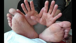 COXSACKIE VIRUS Symptoms Causes Transmission Treatment Hand Foot Mouth disease Herpangina [upl. by Gurango]