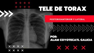 Tele de Tórax Posteroanterior y Lateral [upl. by Perrine]