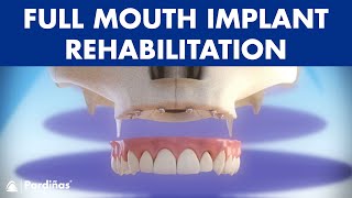 Full mouth rehabilitation with 6 dental implants and fixed denture © [upl. by O'Callaghan]