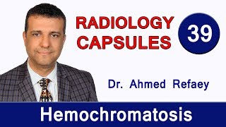 Capsule 39  Hemochromatosis [upl. by Hoseia]