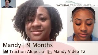 Black Hair Transplant Before and After  Black Hair Transplant Specialist Mandy [upl. by Ever]