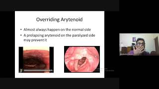 Management of Vocal Cord Palsy Webinar by Dr Jayakumar Menon on World Voice Day2021 [upl. by Sparkie]