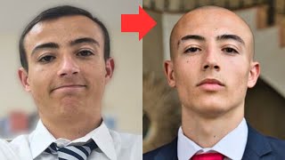 BALDING 17 to 18 Years Old [upl. by Nalhsa]