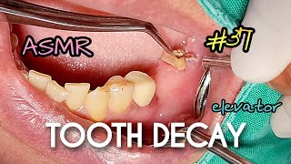 ASMR Severely Broken Tooth Decay Extraction [upl. by Saree]