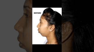 How To Correct Facial Asymmetry  Dr Parit Ladani [upl. by Bernadene]