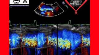 Severe Aortic Regurgitation [upl. by Lednic291]