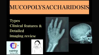 MUCOPOLYSACCHARIDOSIS Case discussion of types clinicoradiological features Morquios amp Hurlers [upl. by Allecnirp424]