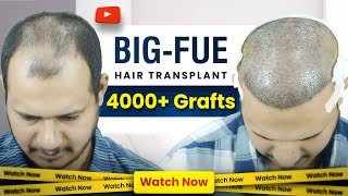 Hair Transplant in Hyderabad  Best Hair Transplant Cost and Hair Transplant Doctor in Hyderabad [upl. by Wildermuth361]