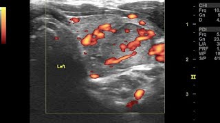 Focal acute viral thyroiditis left lobe with multinodular goiter ultrasound color Doppler video [upl. by Yelssew987]