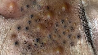 TREATMENT OF BIG BLACKHEADS AND HIDDEN ACNE FOR THE ELDERLY [upl. by Htehpaj572]