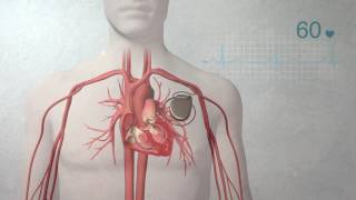 What is a pacemaker [upl. by Drhacir]