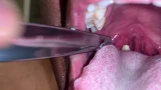 Large Tonsil Stone Removal [upl. by Ettenil]