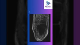 Tendoachilles insertional tear [upl. by Nehttam]