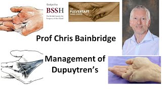 Management of Dupuytrens Contracture by Prof Chris Bainbridge [upl. by Seamus]