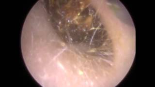 205 Ear Wax Teased and Wriggled out of Narrow Ear Canal  Mr Neel Raithatha THC [upl. by Ahseiym]