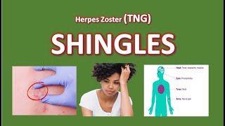 Shingles Management Risk Factor Infections and Treatments [upl. by Eremaj]