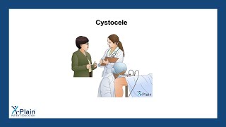 Cystocele [upl. by Yelnats]