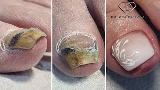 Bruised toe nail transformation Pedicure Removing bruised toe nail doing faded french extension [upl. by Cassandry]