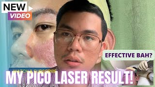 My Pico Laser Treatment Result  Before and After [upl. by Nesbitt]