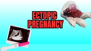 Ectopic Pregnancy  Causes Symptoms And Risks [upl. by Maryjane]