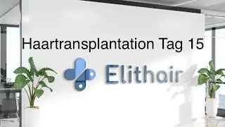 Das erwartet euch  14 Tage nach Haartransplanation bei Elithair [upl. by Aronas]