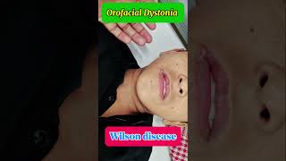 Orofacial dyskinesia  oromandibular dystonia  wilson disease [upl. by Ohce]