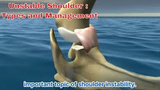 Mastering Shoulder Instability The Ultimate Guide To Types And Treatment 어깨 불안정성  유형과 치료의 모든 것 [upl. by Vardon830]