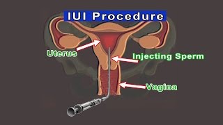 IUI Intrauterine Insemination [upl. by Ro848]