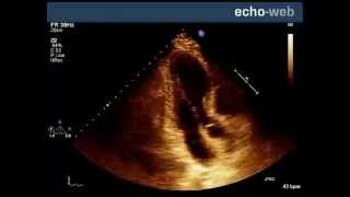 Determining the origin of ventricular ectopic beats on the ECG  Ask Andrew [upl. by Gnilrits]