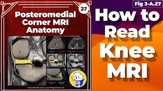 Fig 3A27 Posteromedial Corner MRI Anatomy Posterior Oblique Ligament [upl. by Idner]