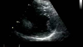 ACUTE CORONARY SYNDROME  HYPOKINESIA [upl. by Kinata355]