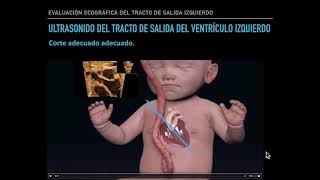 Evaluación del tracto de salida del ventrículo izquierdo [upl. by Cody313]