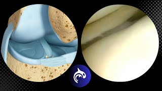 Watch a Knee Surgeon fix a Torn  Locked Meniscus knee kneepain kneepainrelief [upl. by Bogart]