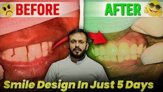 Smile Design just in 5 Days  smile designing treatment [upl. by Greenlee]