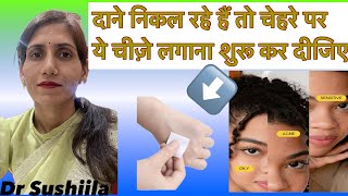 Acne को कैसे ट्रीट करें क्यों होता है Acne Best Acne Treatment [upl. by Keffer]