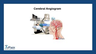 Cerebral Angiogram [upl. by Al]