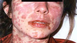 Dermatologic Emergencies 2 StevensJohnson Syndrome Toxic Epidermal Necrolysis [upl. by Lankton]