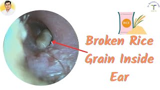 Very Difficult to Remove Swollen Rice 🌾 🌾🌾🌾Grain Inside Ear👂👂👂👂 [upl. by Sherris]