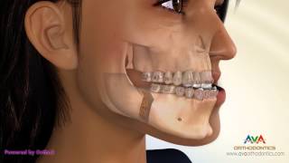 Surgical Orthodontic Treatment for Underbite or Crossbite  BSSO Mandibular Setback [upl. by Erolyat]