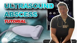 Ultrasound Guided Abscess Drainage [upl. by Hsinam]