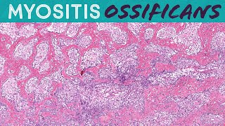 Myositis Ossificans benign mimic of sarcoma bonesoft tissue pathology amp radiology correlation [upl. by Ave]