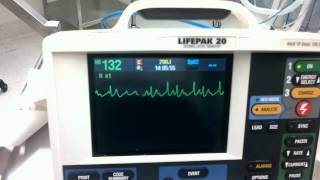 Chemical cardioversion of tachycardia to dx Flutter [upl. by Amadus888]