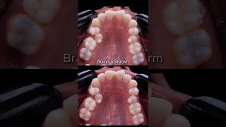 Braces transformation  crooked teeth not extraction braces orthodontist bracesoff dentist [upl. by Llerral]