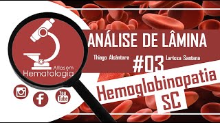 Análise de lâmina 03Hemoglobinopatia SC [upl. by Magna809]