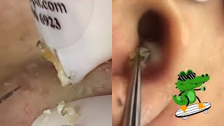 Ultimate ASMR Pimple Popping Compilation  Blackhead amp Cyst Extraction for Maximum Relaxation [upl. by Wolford]