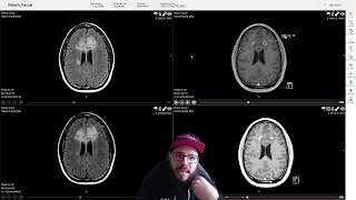 Hirntumor WHO Grade 4 Eine Zweite Biopsie steht bevor [upl. by Anairotciv]