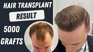 Hair Transplant Before and After 5000 Grafts Result 12 months  Hair Transplant Timelapse [upl. by Holms]