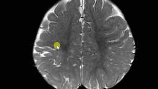 Perinatal hypoxic injuty with white matter paucity and gliosis Ulegyria [upl. by Adnilem]