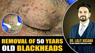 REMOVAL OF 50 YEARS OLD BLACKHEADS II Dr Lalit Kasanas [upl. by Nalyd282]