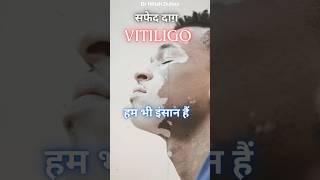 vitiligo awareness shorts vitiligo skincare [upl. by Ziom]